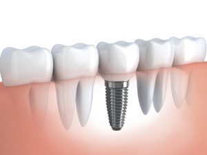 How It All Started: The Interesting History of Dental Implants