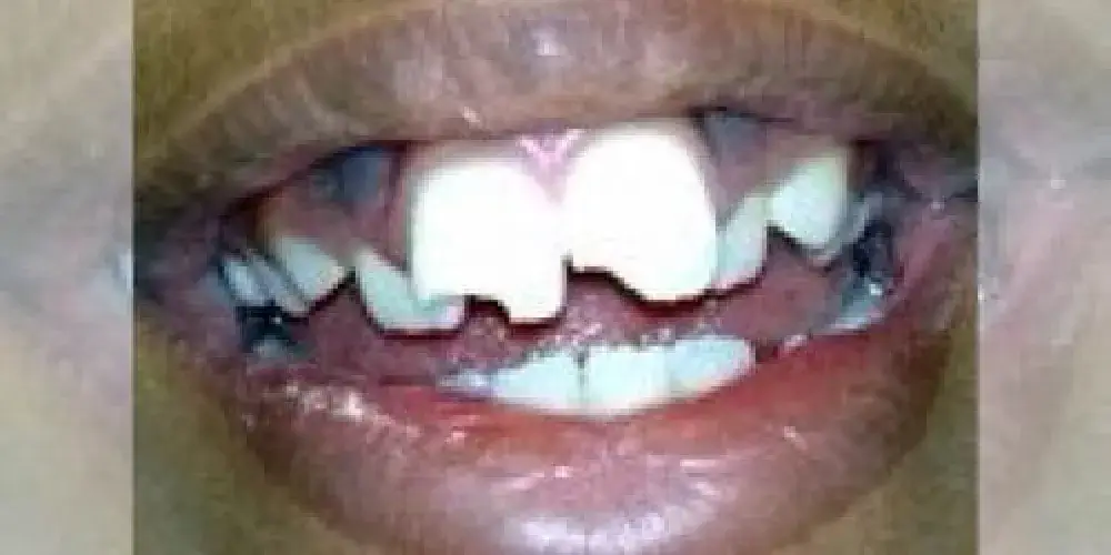 A person with a broken front tooth and uneven dental alignment, showing upper and lower teeth.