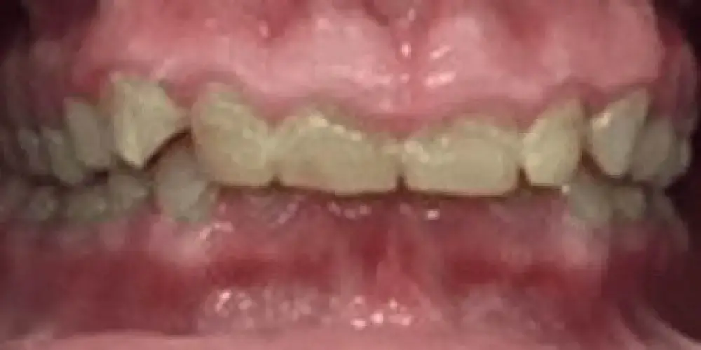 A close-up of a person's slightly misaligned teeth with some discoloration.