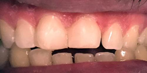 After Dental Procedure